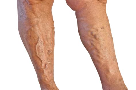 Varicose Veins Causes - Grand Junction Vein Center