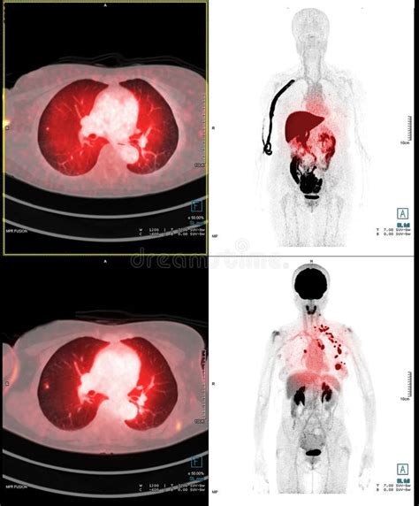 PET Scan Image of Whole Human Body Stock Photo - Image of corona ...