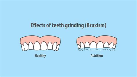 4 Reasons You Grind Your Teeth - Oak Park Dental Group