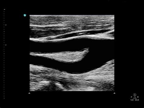 Carotid Artery D Neusoft Medical Latinoam Rica