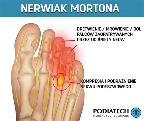 Nerwiak Mortona wkładki ortopedyczne Podiatech