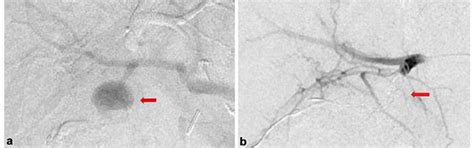 Angiography Showing The Cystic Artery Pseudoaneurysm Before Download Scientific Diagram