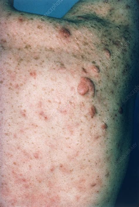 Keloid Scar From Acne