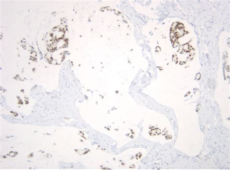 Metastasis Of Rectal Adenocarcinoma To The Penis And Scrotum In An