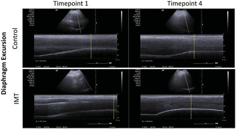 The M Mode Images Of Diaphragmatic Excursion In The Ctl Group And The