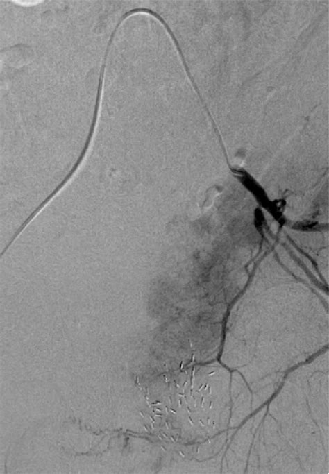 Pre Embolization Image Of Left Internal Iliac Angiogram Demonstrating Download Scientific