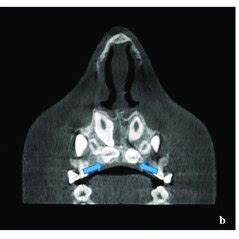 The Sagital A Axial B And Coronal C Slices Of Cbct Show An Impacted