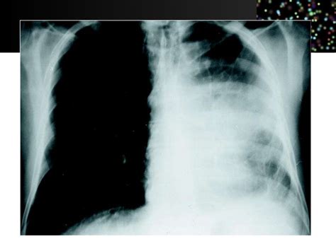 Derrame Pleural Y Atelectasia