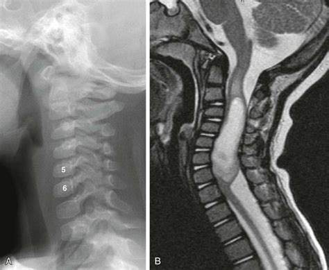 Spinal Cord Imaging Techniques Radiology Key