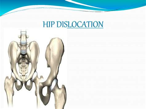 SOLUTION Congenital Hip Dislocation Studypool