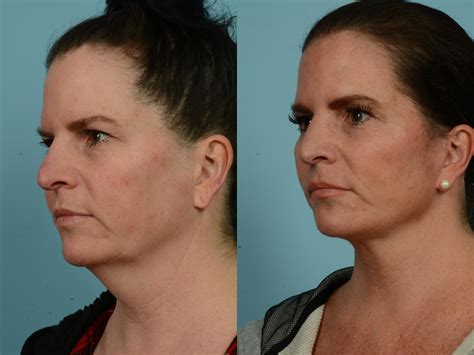 Facelift Before And After Photos Prove Just How Natural Todays Results Look Tlkm Plastic Surgery