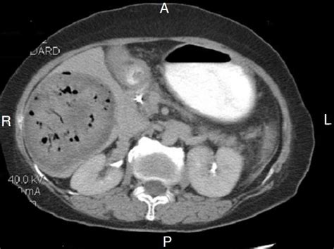 Contrast Enhanced Computed Tomography Of The Abdomen Demonstrates Gas