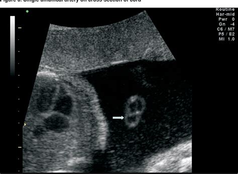 Fetal Soft Markers In Obstetric Ultrasound Semantic Scholar