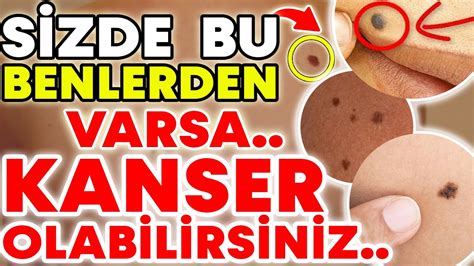 Bu Benlerden Sizde Var Ise Kanser Olabilirsiniz Benlerin En Nemli