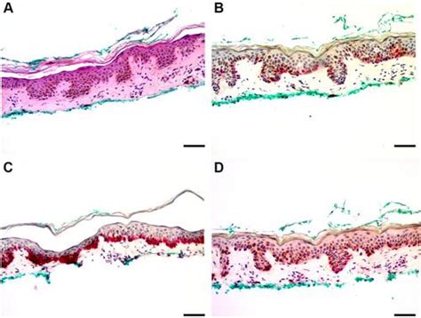 Full Article Comparison Of Sox Hmb And Melan A In Benign