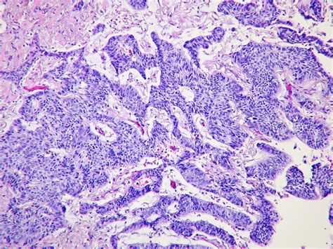 Basaloid Squamous Cell Carcinoma Case 275 Lobectomy Flickr