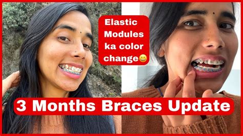 3 Months Braces Update Wire Tightening Vlog 😥 Bracesjourney Mandi