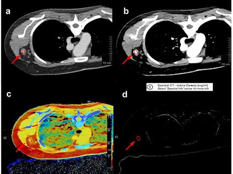 Frontiers Detection Of Axillary Lymph Node Metastasis In Breast