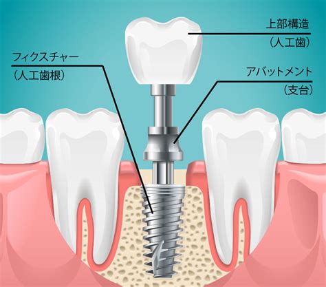 インプラント治療 八千代緑が丘の歯医者なら、マイ歯科医院