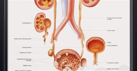 Diseases Of The Urinary Tract Anatomy Poster We The Ojays And Health