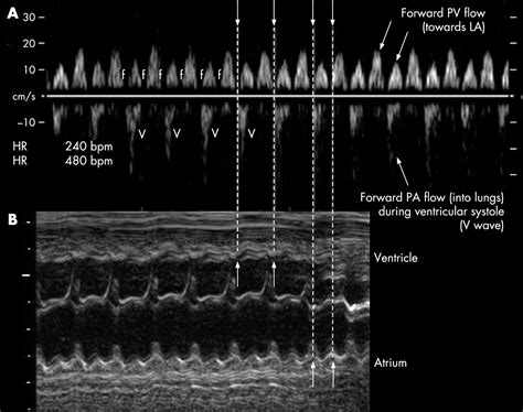 Pulsed Wave Doppler