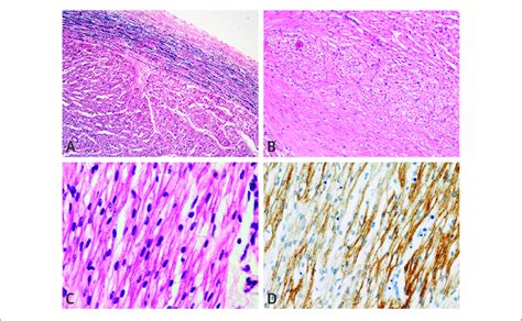 Histopathological Examination Of Heart Tissue In Alpk Related