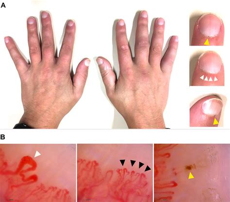 Systemic Scleroderma Hands