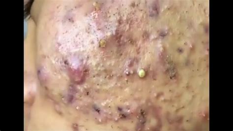 Big Pimple Popping Satisfying Blackhead Face Removal 2023 Unbelievable