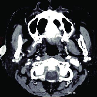 Preoperative Computed Tomography Scan Showing A Contrastenhanced