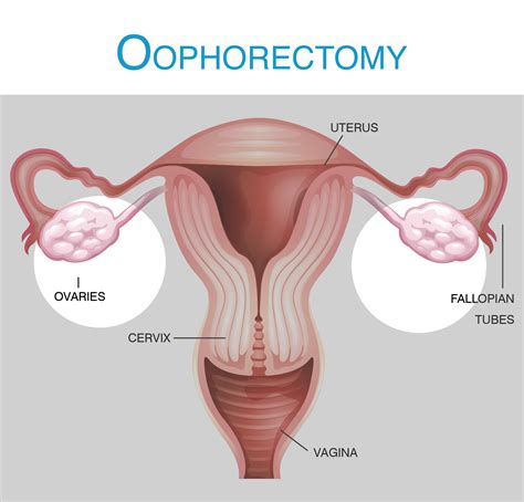 Hysterectomy Oophorectomy