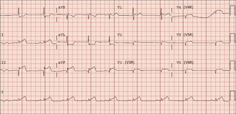 Ecg Diagnosis Right Ventricular Myocardial Infarction The Permanente