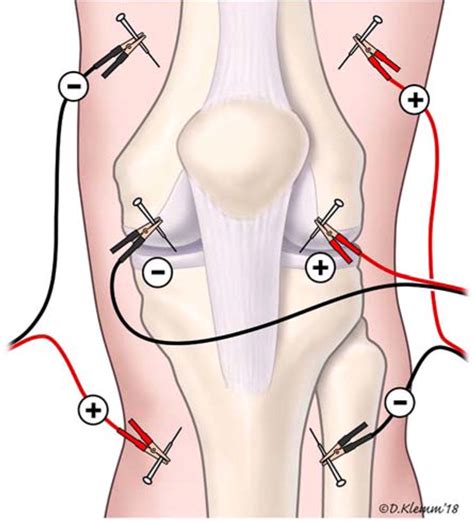 Acupuncture Nerve Pain Relief