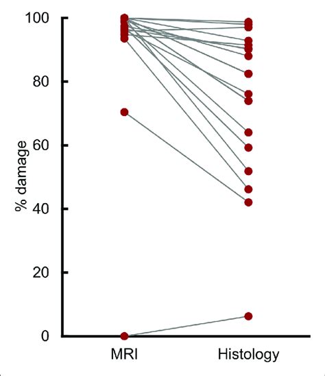 | T2 magnetic resonance imaging (MRI) overestimated amygdala damage ... 