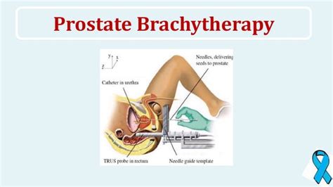 Prostate Cancer Ppt