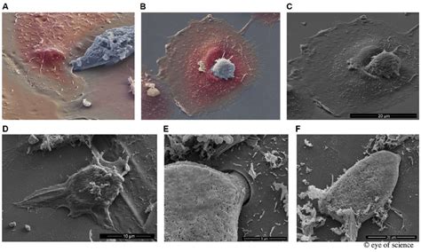 Entamoeba Gingivalis