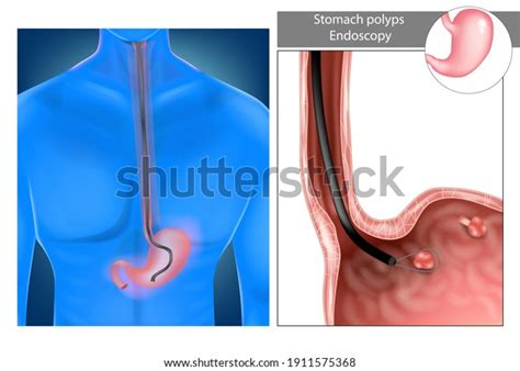 Removal Gastric Polyps Stomach Upper Endoscopy Stock Vector (Royalty ...