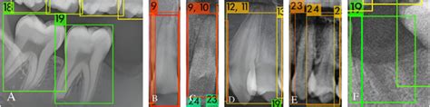 Automated Permanent Tooth Detection And Numbering On Panoramic Radiograph Using A Deep Learning