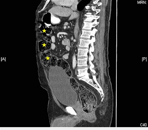 Ct Scan Sagittal View Demonstrating Inflammatory Changes Surrounding