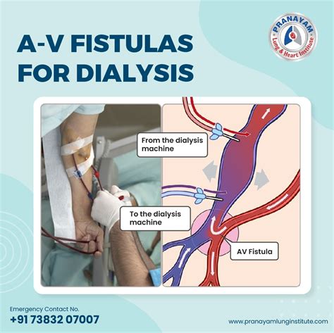 Fistula Dialysis