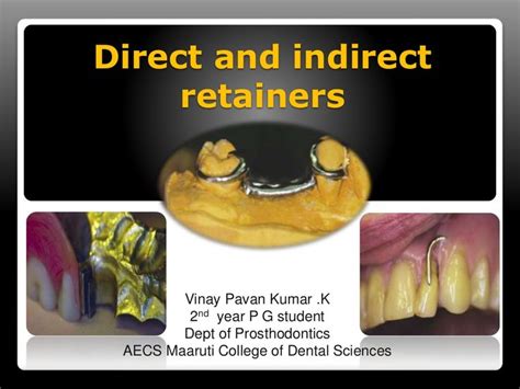 Direct And Indirect Retainers In Rpd Retainers Directions Dental