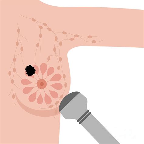 Breast Ultrasound By Pikovit Science Photo Library