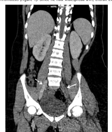 Figure From Pediatric Deep Venous Thrombosis And Pulmonary Embolism