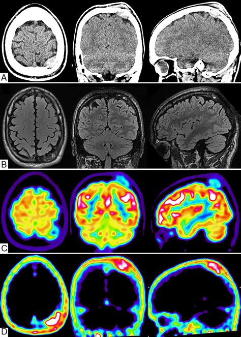 Ga Dotatoc Pet Ctguided Resection Of A Primary Intraosseous