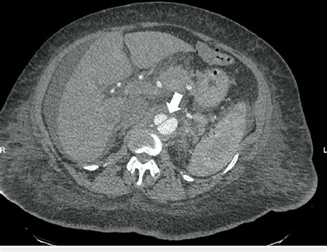 Computed Tomography Angiogram Abdomen And Pelvis The White Arrow