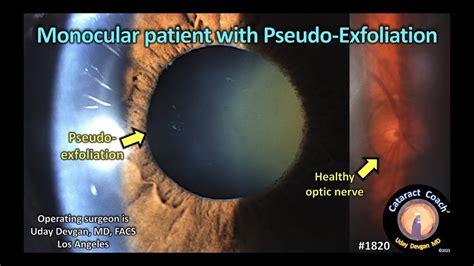 Pseudoexfoliation Gonioscopy