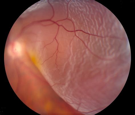 Retinal Detachment Causes Symptoms And Treatments