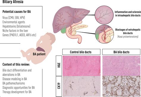 Biliary Atresia Diagnose Medizzy