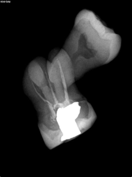 Figure 3 Specimen Radiograph Showing Concrescent Second And Third