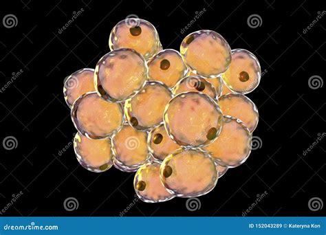 Lipoma Adipose Tumors Skin Layers Vector Illustration CartoonDealer