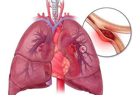 15 Types Of Thrombosis Explained With Illustrations